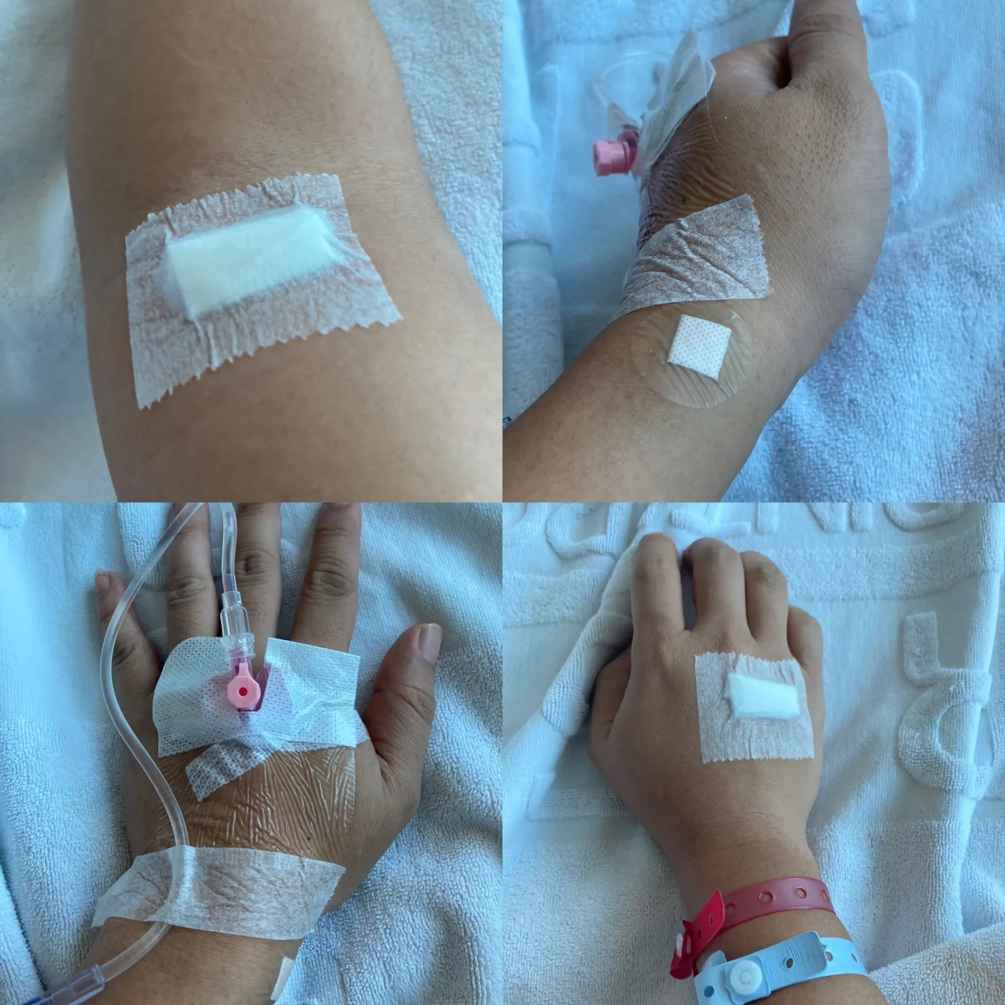 Collage of 4 photos of various injection marks on my hand