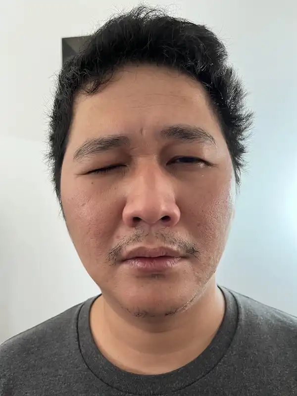 右半分が麻痺したリファットの顔